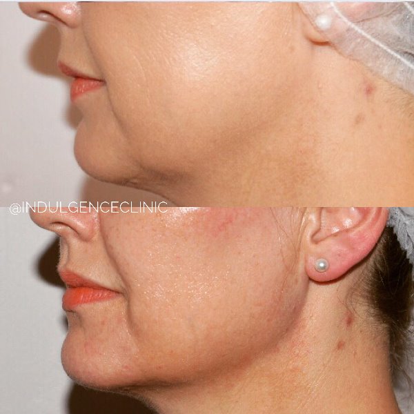 Dermal Filler to Jawline